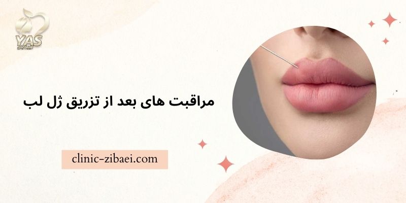 مراقبت های بعد از تزریق ژل لب کلینیک زیبایی