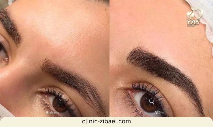 نحوه کاشت ابروی طبیعی پهن در کلینیک زیبایی یاس