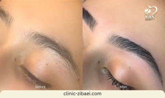 نحوه کاشت ابروی طبیعی پهن