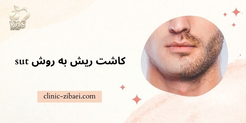 کاشت ریش به روش sut در کلینیک زیبایی