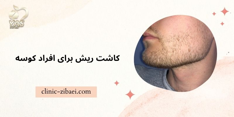 کاشت ریش برای افراد کوسه در کلینیک زیبایی