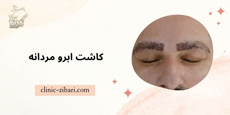 کاشت ابرو مردانه در کلینیک زیبایی