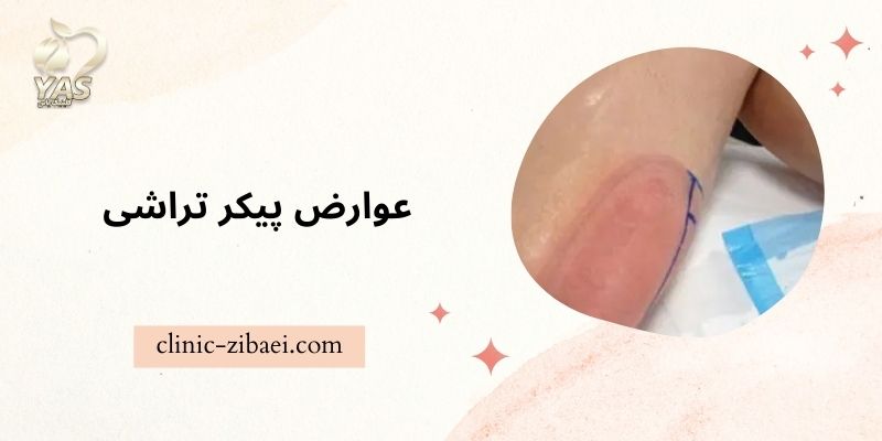 عوارض پیکر تراشی شکم و پهلو در کلینیک زیبایی یاس