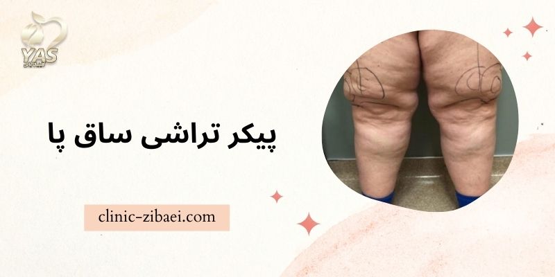 پیکر تراشی ساق پا در کلینیک زیبایی یاس