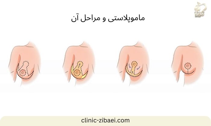 عوارض نادر ماموپلاستی در کلینیک زیبایی یاس