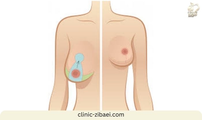 تفاوت بین ماموپلاستی بزرگ‌کردن و کوچک‌کردن سینه در کلینیک زیبایی یاس
