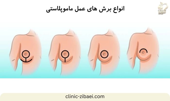 چه افرادی به عمل ماموپلاستی احتیاج دارند؟ کلینیک زیبایی یاس