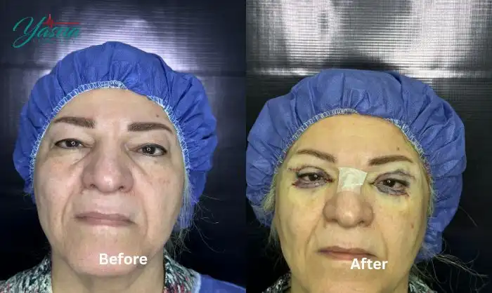 نمونه کار عمل بلفاروپلاستی