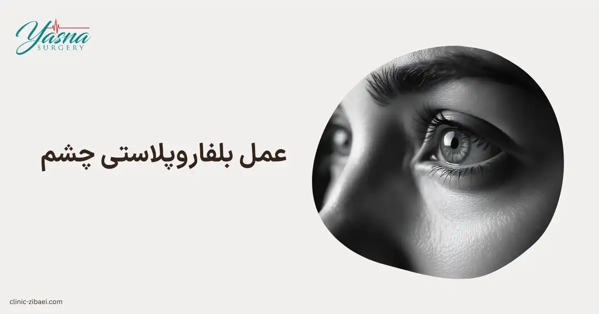 عمل بلفاروپلاستی