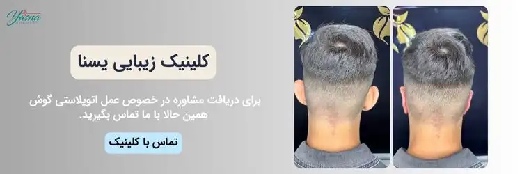 مشاوره عمل اتوپلاستی