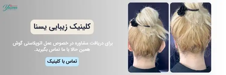 مشاوره عمل اتوپلاستی