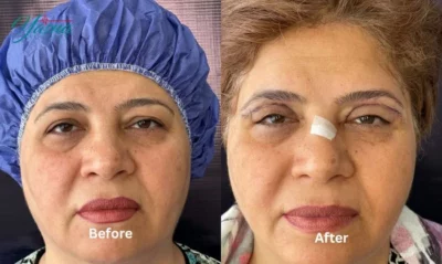 نمونه کار جراحی بلفاروپلاستی 1