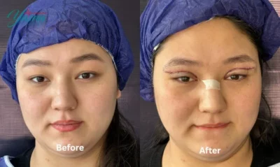 نمونه کار جراحی بلفاروپلاستی 2