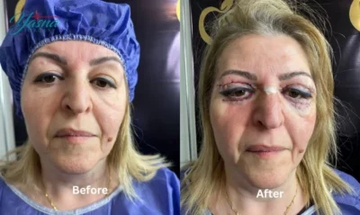 نمونه کار جراحی بلفاروپلاستی 3