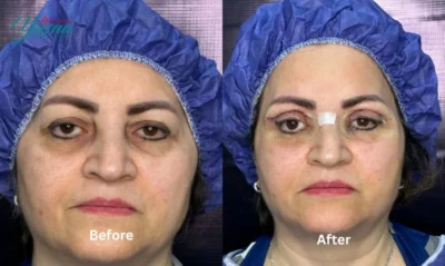 نمونه کار جراحی بلفاروپلاستی