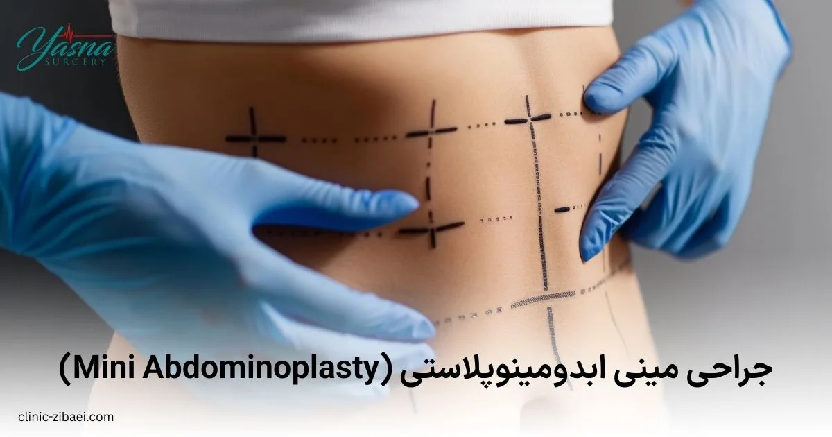مینی ابدومینوپلاستی (Mini Abdominoplasty)