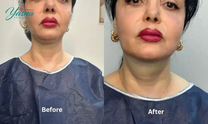 نمونه کار ساکشن غبغب 3