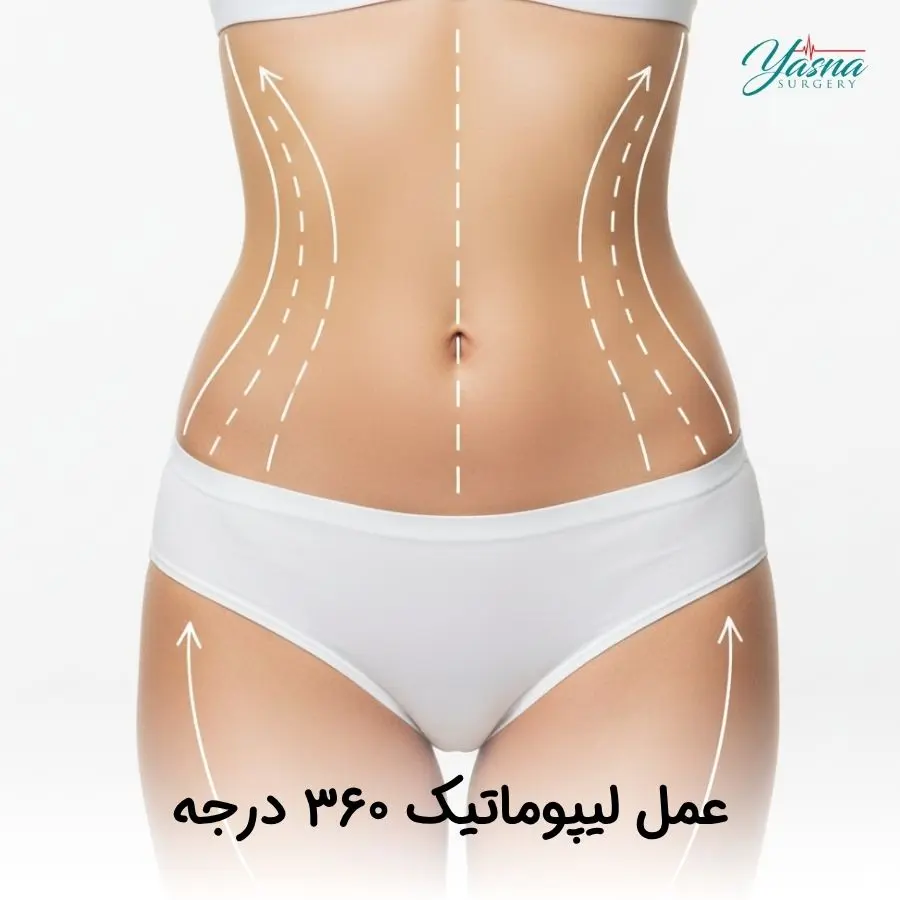 عمل لیپوماتیک ۳۶۰ درجه