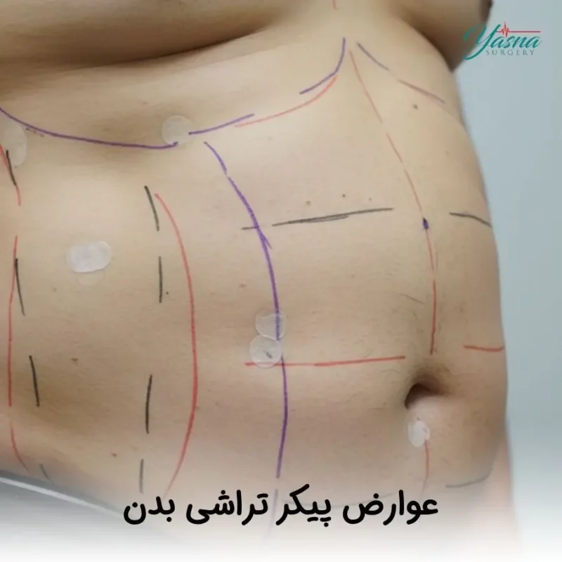 عوارض پیکرتراشی بدن