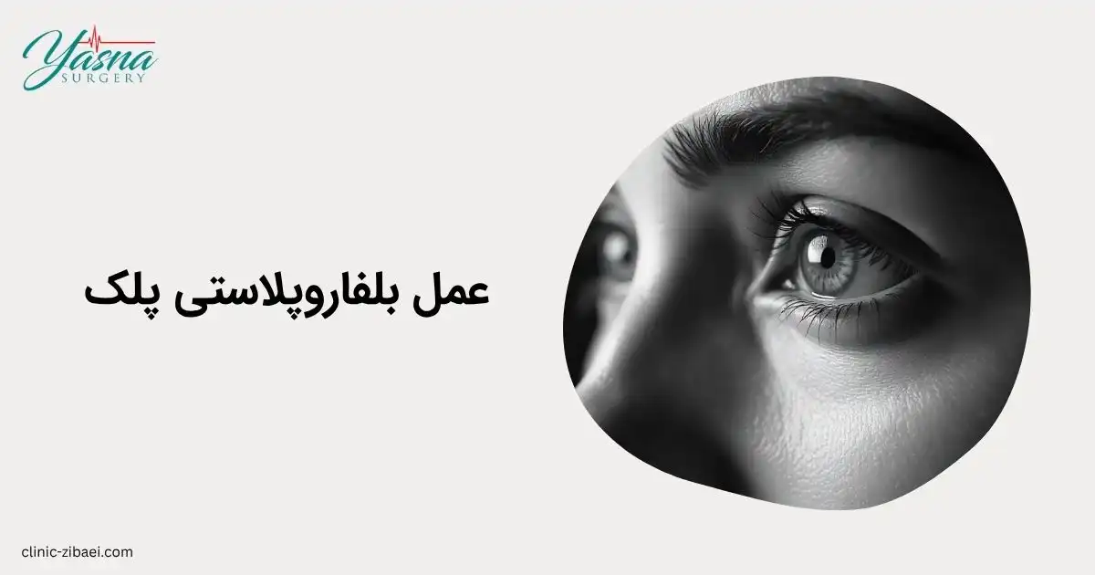 عمل بلفاروپلاستی پلک