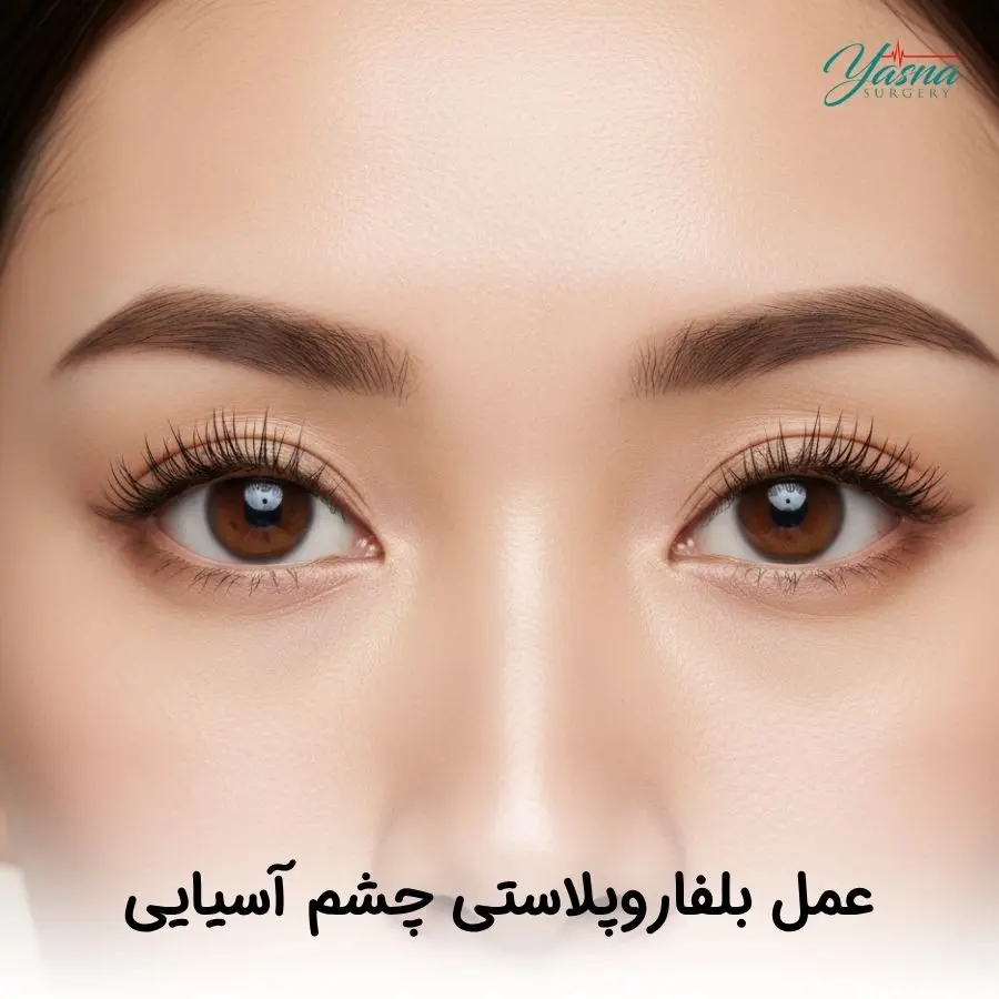 عمل بلفاروپلاستی چشم آسیایی